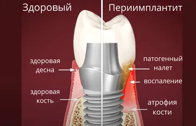 Свищ возле импланта: почему возникает данное осложнение и как бороться