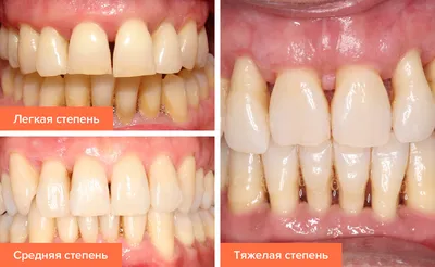 Воспаление десен – лечение, как снять, чем полоскать (лекарство, мазь,  антибиотик)