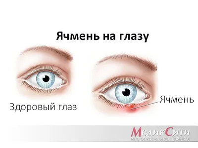 Покраснение глаз при конъюнктивите - энциклопедия Ochkov.net