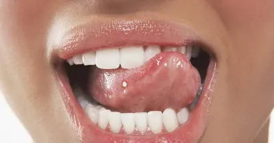 Воспаление языка сбоку фото фото