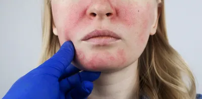 Воспаление кожи лица фото фото