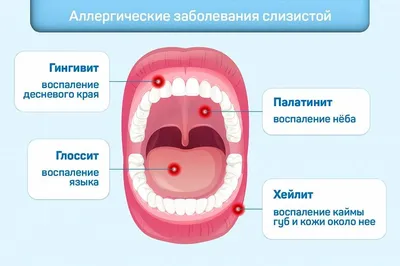 Посоветуйте, чем лечить Воспаление верхнего нёба - Терапия - Стоматология  для всех