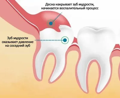 Черные точки на небе во рту: причины и методы борьбы