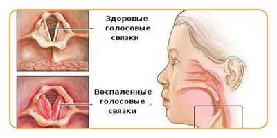 Туберкулез полости рта - причины, симптомы, диагностика, лечение