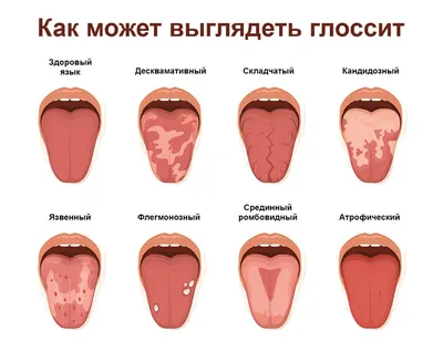 Красные пятна на языке : виды, причины, симптомы и лечение гололосита