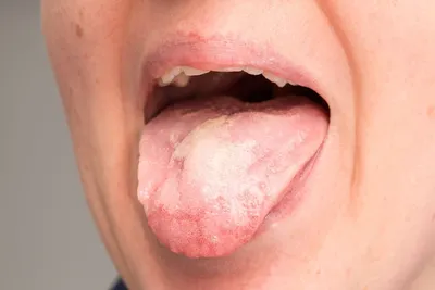 Воспаление стоматита языка, рак языка стоковое фото ©fukume 454118864