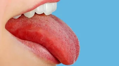 Воспаление слизистой оболочки во рту под языком: причины, симптомы, лечение