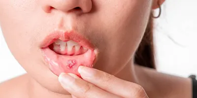 Воспаление под языком: причины возникновения, симптомы, лечение,  профилактика.