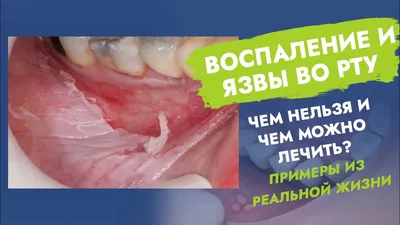 Основные симптомы воспаление языка (глоссита), виды, лечение – Стоматология  «АльфаДент» в Оренбурге