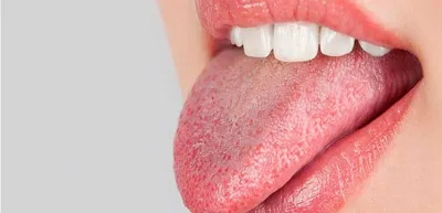 Воспаление слизистой оболочки полости рта, лечение