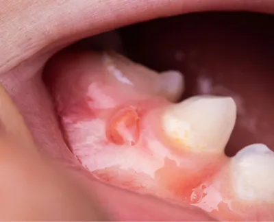 Антибиотики при воспалении десен и корней зубов взрослым и детям