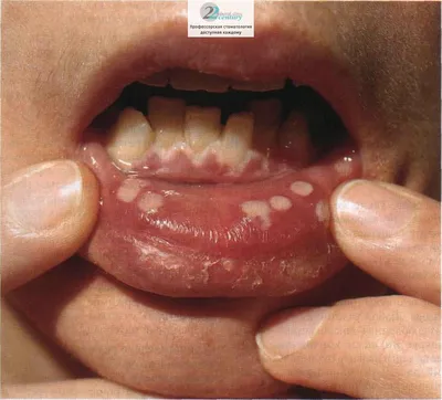 Абсцесс зуба: какие симптомы и что с ним делать