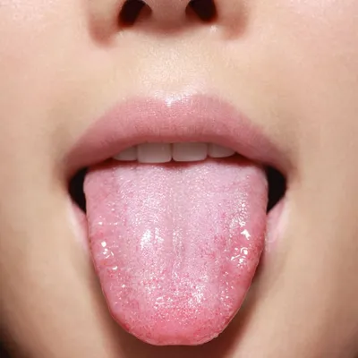 Стоматология Da Vinci - 6 видов стоматита. Что это за заболевание?  Воспаление слизистой рта. В добавок к нему появляются язвочки, ранки и  эрозии. Всё это даёт неприятные и болезненные ощущения. Его лечение