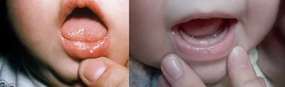 Luxendent - Стоматит - воспаление слизистой оболочки полости рта - очень  частое заболевание у детей! Почему развивается стоматит? Как его лечить? И  какие средства навредят, а не помогут? «Чаще стоматит развивается у