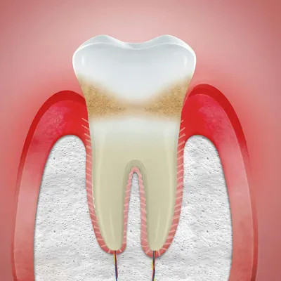 Рецессия десны [причины, стоимость лечения, симптомы]