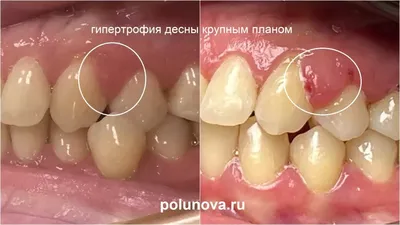 Гнойник на десне - причины, симптомы, признаки, диагностика, лечение,  профилактика абсцесса десны