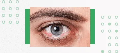 Причины кератита. Лечение заболеваний глаз в АО Семейный доктор
