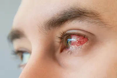 Воспаление роговицы глаза - кератит | Moseyes