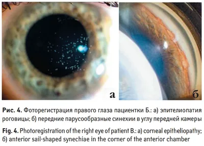 Как сохранить зрение / Воспалительные заболевания глаз. Часть 05 |  ЮТА-Клиник | Дзен