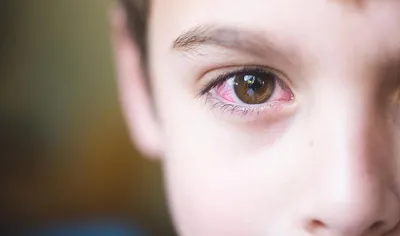 Рис. 4. Фоторегистрация правого глаза пациентки Б.: а) эпителиопатия р…