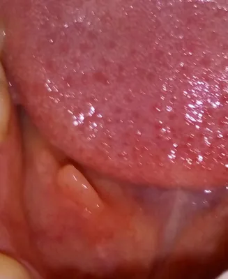 Воспаление слюнной железы под языком фото фото