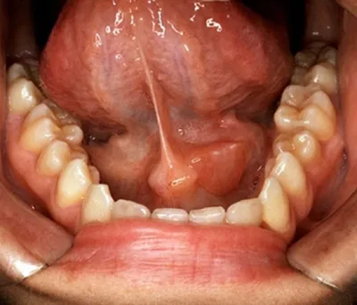 Отек под языком - Хирургическая стоматология - Стоматология для всех