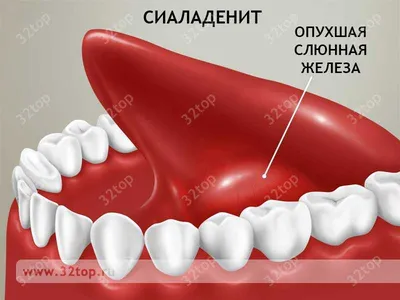 Сиаладенит слюнной железы: лечение, симптомы и формы сиаладенита