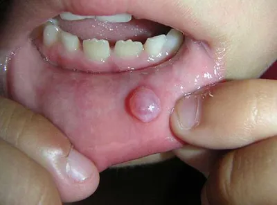 Ксеростомия: сухость во рту, лечение, стадии развития
