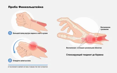 Тендовагинит - симптомы по дням у детей и взрослых, диагностика и способы  лечения