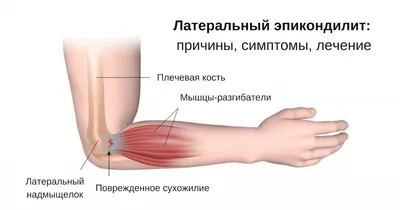 Эпикондилит - лечение в Киеве - Vertebra