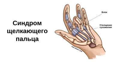 Фиксатор запястья при заболеваниях кисти руки: когда и для чего он нужен