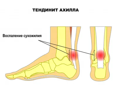 Тейпирование запястья при растяжении | Академия ТТ