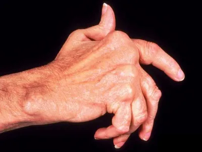 Травмы: разрывы связок кисти, растяжения, воспаления, надрывы связок на  пальцах, запястье руки – Симптомы, лечение, восстановление