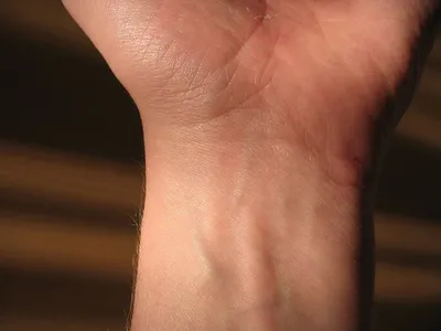 Лечение боли в суставах рук в центре кинезитерапии в Фрязино -  Реабилитационный центр Фрязино