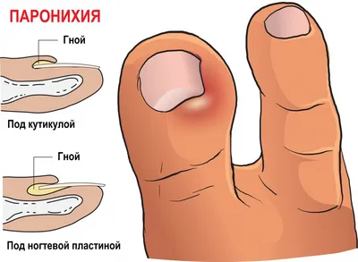 Лечение тендинита в Екатеринбурге - Новая больница