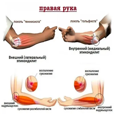 Почему сводит пальцы на руках: от судорог в кистях до профилактики