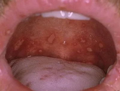 Поражения слизистой оболочки рта при системной красной волчанке -  DENTALMAGAZINE.RU