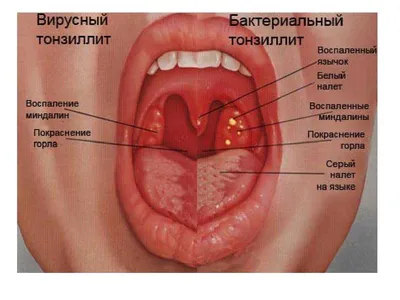 Воспаление нёба (палатинит): причины, симптомы, диагностика, лечение воспаления  нёба верхнего, твёрдого, мягкого