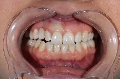 Первые признаки стоматологических заболеваний у детей