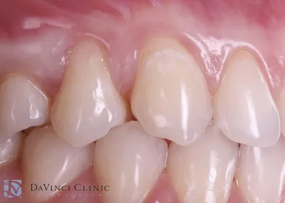 Этапы имплантации зубов | Как делают имплантацию зубов, пошаговое описание  каждого этапа
