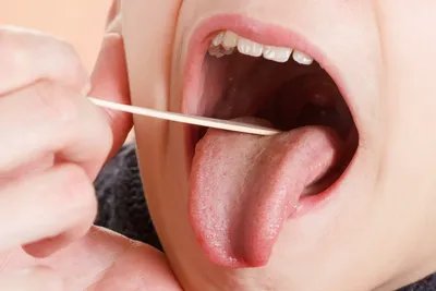 Абсцесс полости рта — острое гнойное воспаление | TopDent | Дзен