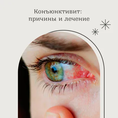 Шишка на веке (халязион) - причины и лечение - Офтальмологические клиники  «Эксимер» (Киев) – диагностика и лечение заболеваний глаз у взрослых и  детей Киев