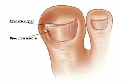 Подногтевая гематома - причины, симптомы, диагностика, лечение и  профилактика