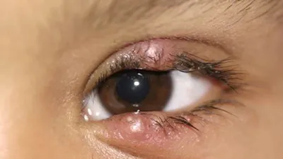 Воспалительные заболевания глаз | Очкарик | Дзен