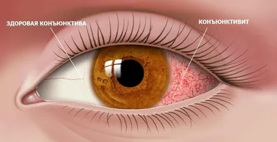 Воспалительные заболевания глаз - причины, симптомы, диагностика, лечение и  профилактика