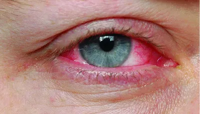 Блефарит – симптомы, причины, диагностика и лечение блефарита глаза век в  клинике «Будь Здоров»