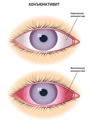 Типы конюнктивита Воспалительные заболевания глаз Иллюстрация вектора -  иллюстрации насчитывающей офтальмология, тягостно: 73470755