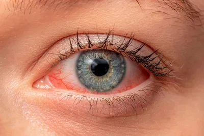 Медицинский центр «Альфамед» on Instagram: \"ВОСПАЛИТЕЛЬНЫЕ ЗАБОЛЕВАНИЯ ГЛАЗ  У ДЕТЕЙ Что делать, если ребёнок проснулся утром, а у него красные глазки,  да еще и слезятся? Если вы заметили первые подобные симптомы, рекомендуем