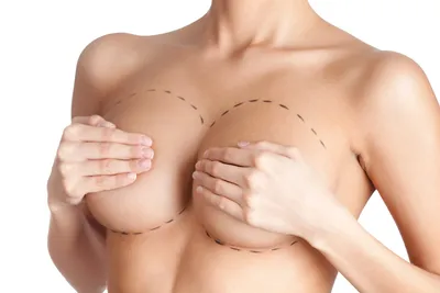 Усовершенствование протезов груди | Институт груди в Париже