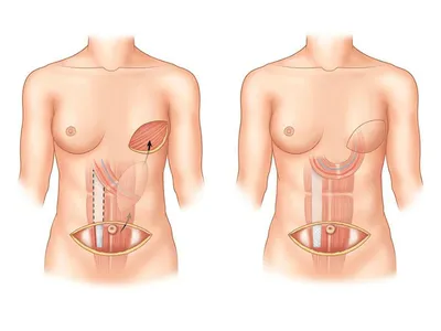 Как восстановить молочную железу после мастэктомии